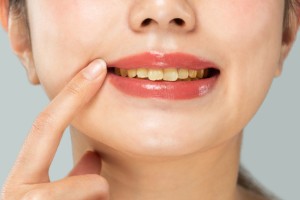 Teeth are crooked　orthodontics